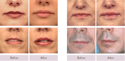 Facial Fillers & Injectables Scottsdale