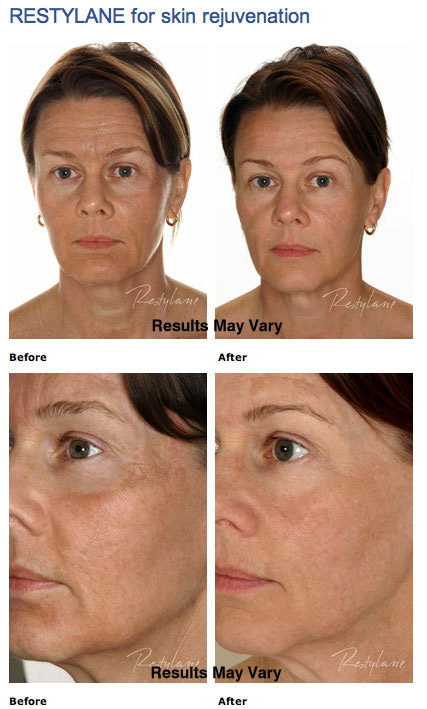 Facial Fillers & Injectables Scottsdale