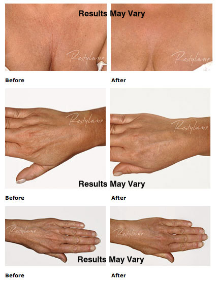 Facial Fillers & Injectables Scottsdale
