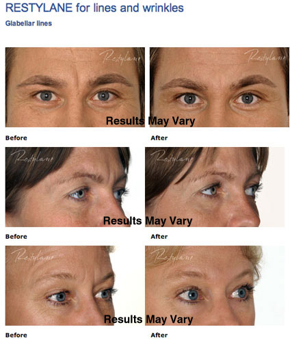 Facial Fillers & Injectables Scottsdale