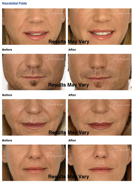 Facial Fillers & Injectables Scottsdale