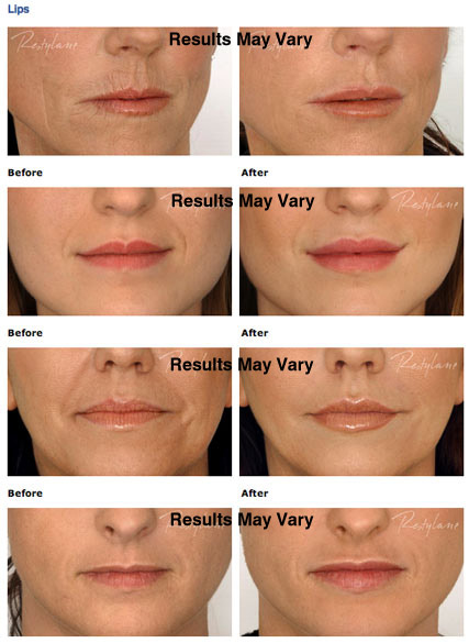Facial Fillers & Injectables Scottsdale