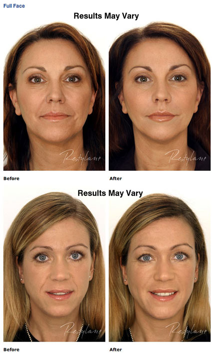 Facial Fillers & Injectables Scottsdale