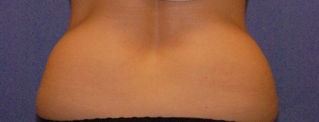 Patient 15 before photo of Coolsculpting patient at Sensational Skin Scottsdale