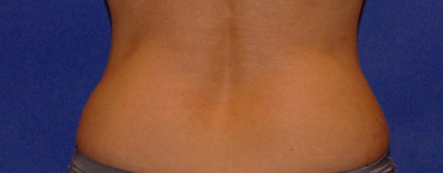 Patient 15 after photo of Coolsculpting patient at Sensational Skin Scottsdale