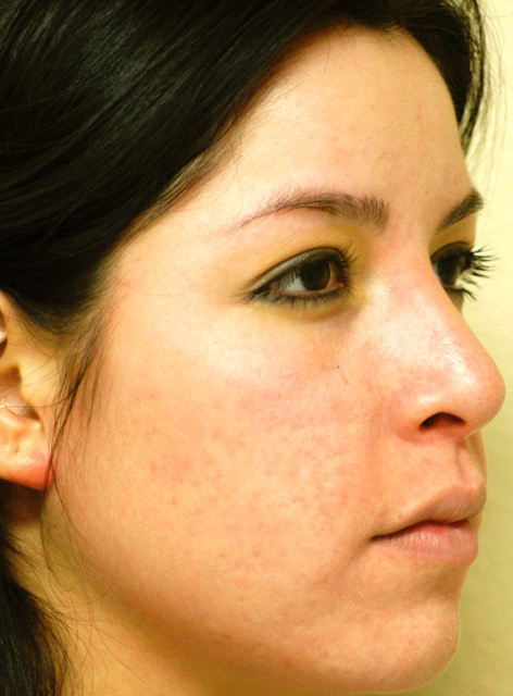Patient 5 after photo of Acne & Acne Scar Laser Treatment patient at Sensational Skin Scottsdale
