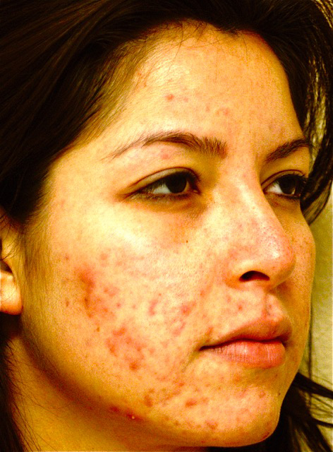 Patient 5 before photo of Acne & Acne Scar Laser Treatment patient at Sensational Skin Scottsdale