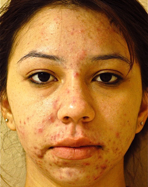 Patient 6 before photo of Acne & Acne Scar Laser Treatment patient at Sensational Skin Scottsdale