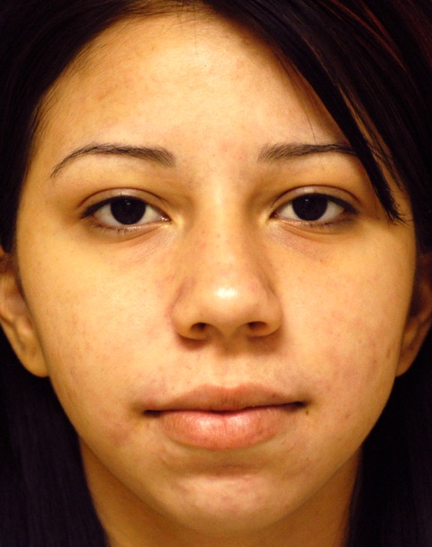 Patient 6 after photo of Acne & Acne Scar Laser Treatment patient at Sensational Skin Scottsdale
