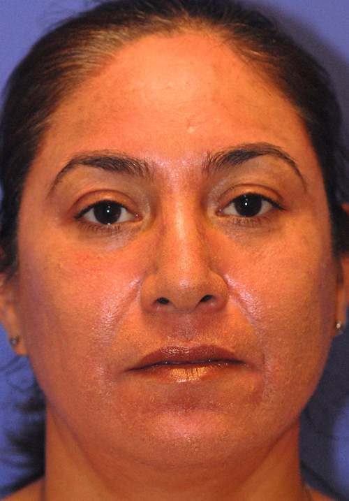 After treatment at Sensational Skin