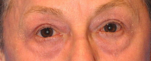 Patient 9 after photo of Laser EyeLid Lift patient at Sensational Skin Scottsdale
