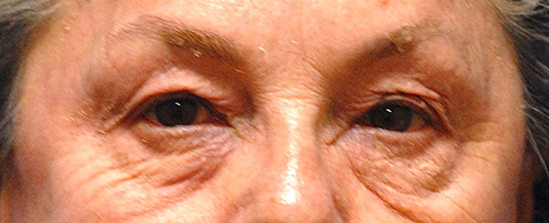 Patient 9 before photo of Laser EyeLid Lift patient at Sensational Skin Scottsdale