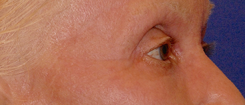 Patient 8 after photo of Laser EyeLid Lift patient at Sensational Skin Scottsdale