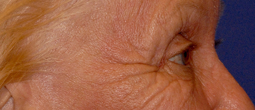 Patient 8 before photo of Laser EyeLid Lift patient at Sensational Skin Scottsdale