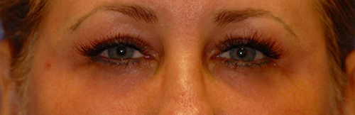 Patient 17 after photo of Laser EyeLid Lift patient at Sensational Skin Scottsdale