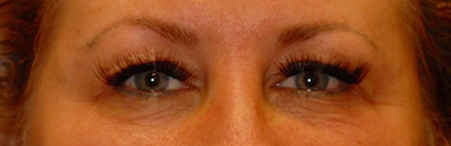 Patient 17 before photo of Laser EyeLid Lift patient at Sensational Skin Scottsdale