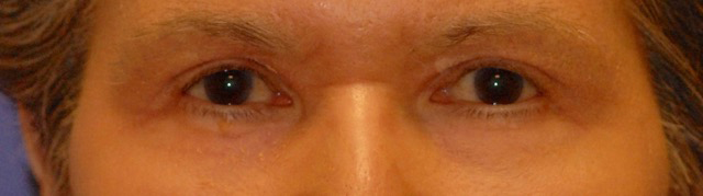 Patient 18 after photo of Laser EyeLid Lift patient at Sensational Skin Scottsdale