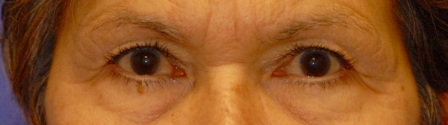 Patient 18 before photo of Laser EyeLid Lift patient at Sensational Skin Scottsdale