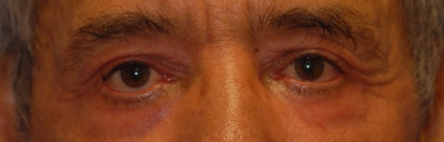 Patient 19 after photo of Laser EyeLid Lift patient at Sensational Skin Scottsdale