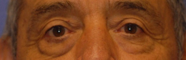 Patient 19 before photo of Laser EyeLid Lift patient at Sensational Skin Scottsdale