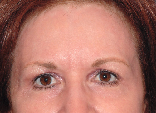 Patient 20 after photo of Laser EyeLid Lift patient at Sensational Skin Scottsdale