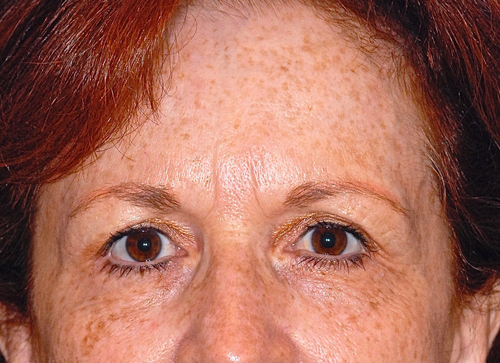 Patient 20 before photo of Laser EyeLid Lift patient at Sensational Skin Scottsdale