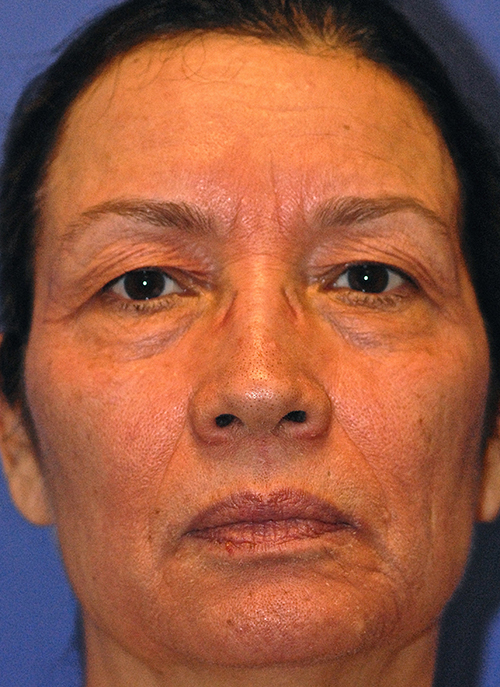 Patient 21 before photo of Laser EyeLid Lift patient at Sensational Skin Scottsdale