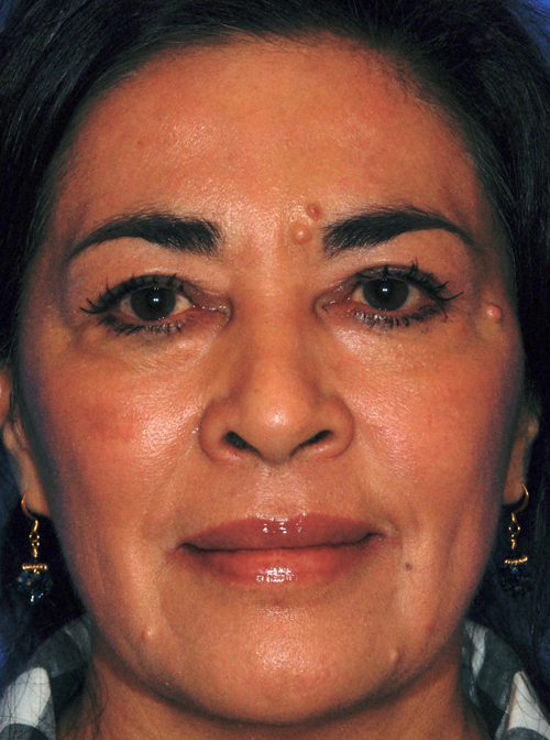After Liquid Facelift