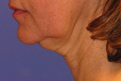 Patient 8 before photo of Ultherapy patient at Sensational Skin Scottsdale