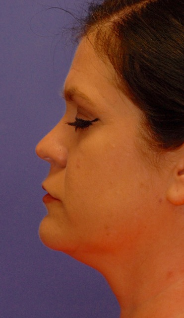 Patient 7 after photo of Ultherapy patient at Sensational Skin Scottsdale