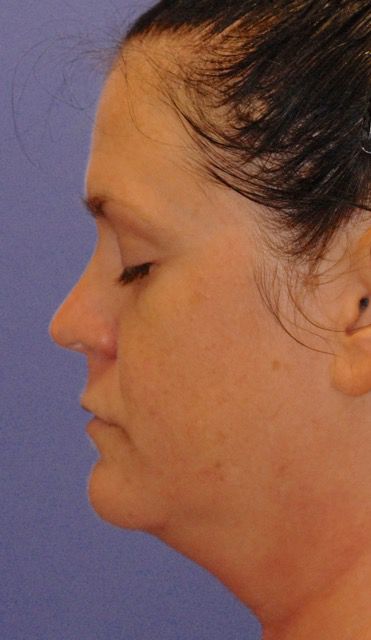 Patient 7 before photo of Ultherapy patient at Sensational Skin Scottsdale