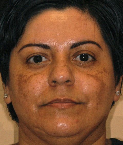 Patient 21 before photo of ZO Skin Health patient at Sensational Skin Scottsdale
