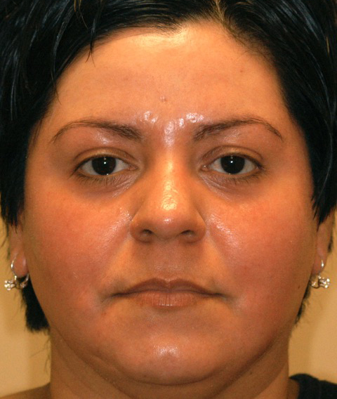 Patient 21 after photo of ZO Skin Health patient at Sensational Skin Scottsdale
