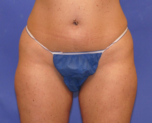 Patient 14 after photo of Coolsculpting patient at Sensational Skin Scottsdale