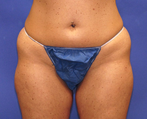 Patient 14 before photo of Coolsculpting patient at Sensational Skin Scottsdale
