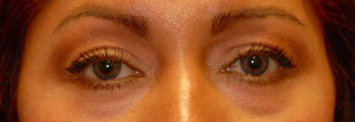 Patient 7 after photo of Laser EyeLid Lift patient at Sensational Skin Scottsdale