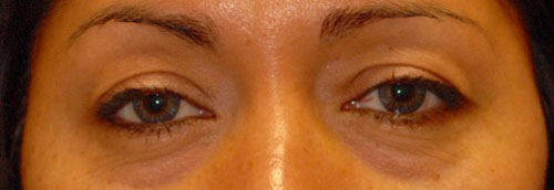 Patient 7 before photo of Laser EyeLid Lift patient at Sensational Skin Scottsdale