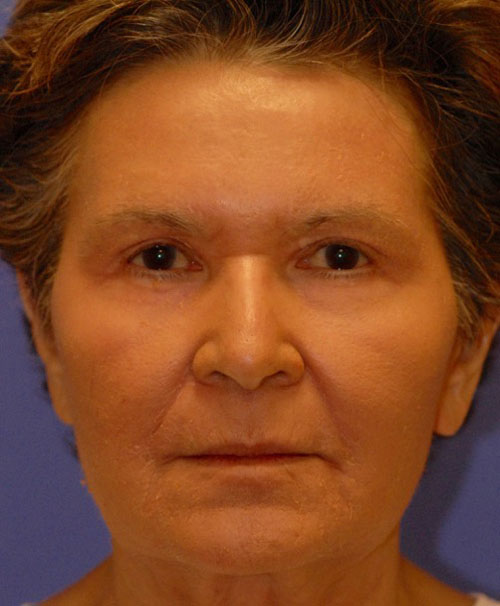 Patient 89 after photo of Face Procedures patient at Sensational Skin Scottsdale