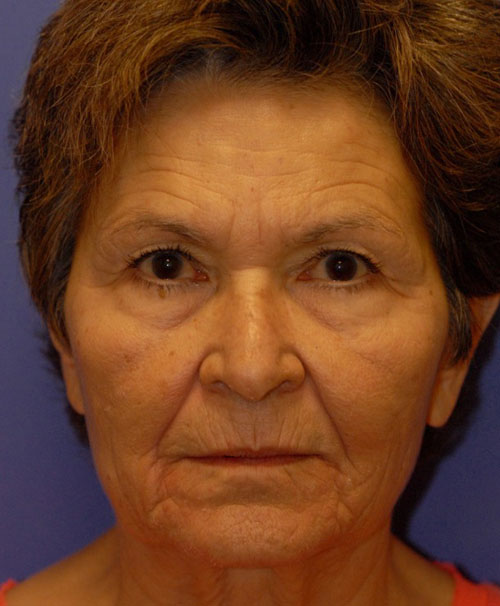 Patient 89 before photo of Face Procedures patient at Sensational Skin Scottsdale