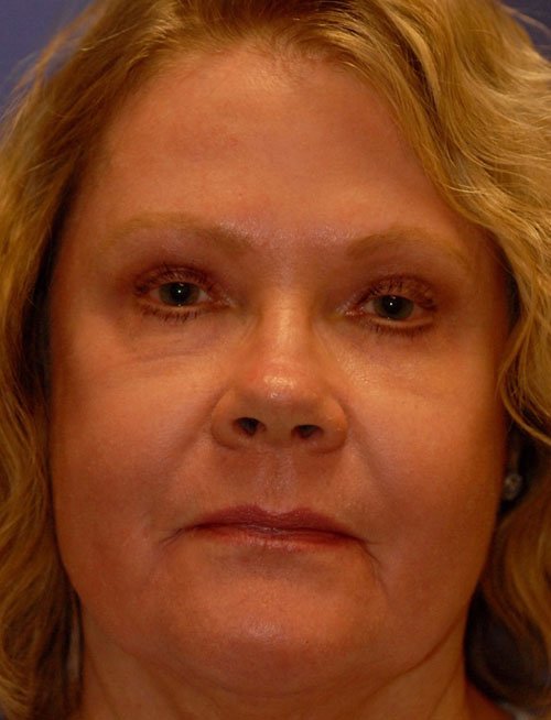 Patient 94 after photo of Face Procedures patient at Sensational Skin Scottsdale