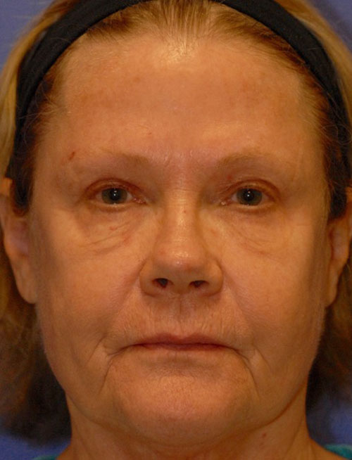 Patient 94 before photo of Face Procedures patient at Sensational Skin Scottsdale
