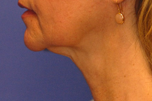 Patient 5 after photo of Ultherapy patient at Sensational Skin Scottsdale