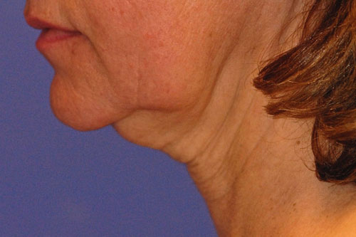 Patient 5 before photo of Ultherapy patient at Sensational Skin Scottsdale