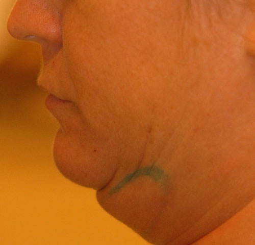 Before Ultherapy