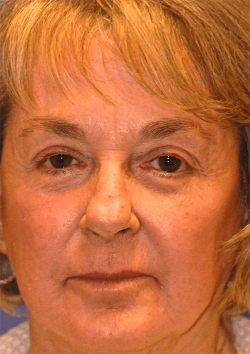 Patient 9 after photo of Ultherapy patient at Sensational Skin Scottsdale