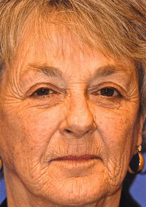 Patient 9 before photo of Ultherapy patient at Sensational Skin Scottsdale