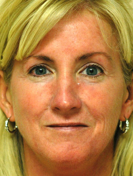 After Rosacea patient