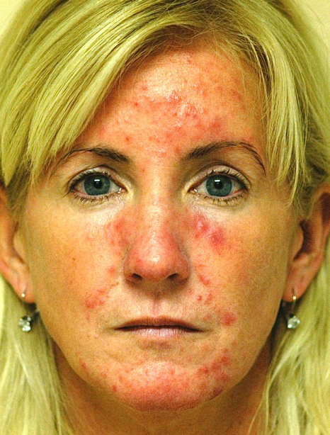 Before Rosacea patient