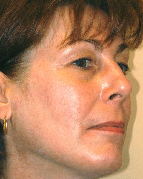 Patient 4 after photo of Photo Facial™ patient at Sensational Skin Scottsdale