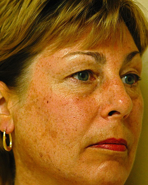 Patient 4 before photo of Photo Facial™ patient at Sensational Skin Scottsdale